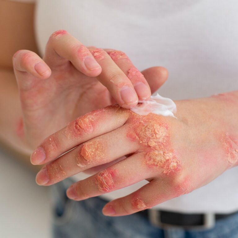 Spider Bites - First Aid
